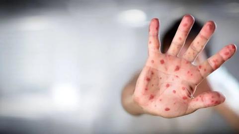 آبله میمون؛ پاسخ به چند پرسش کلیدی درباره یک نگرانی تازه