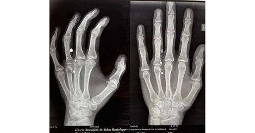 Many pellets are still lodged in Seyed Matin Manani’s body
