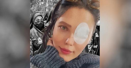 29-year-old psychologist Raheleh Amiri, said of her own injured eye: “These days, when I look in the mirror, my right eye is much smaller than the left one but, to tell the truth, I am in love with my right eye because it glows with honor”