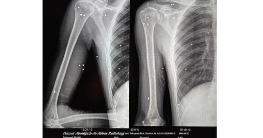 The doctors have decided that it is safer not to remove two pellets lodged near the blood vessels to Seyed Matin Manani’s brain