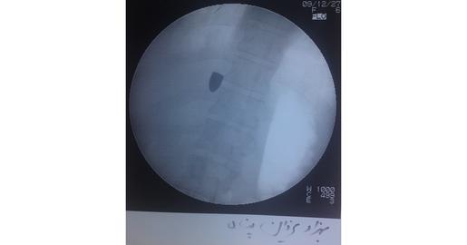 Shot from Behind and Paralyzed: The Survivor of Tehran’s Bloodiest Protest Day