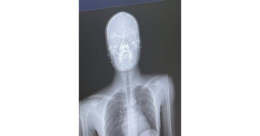 Someone could be seen extracting a pellet from his hand. Erfan’s head, neck and upper chest had been struck. Another pellet that pierced his forearm was set to be removed the day after our meeting