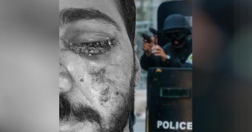 علی محمدی ۳۰شهریور در تجمعات اعتراضی استان همدان از ناحیه سر مورد هدف نیروهای سرکوب قرار گرفت و یک چشم خود را از دست داد