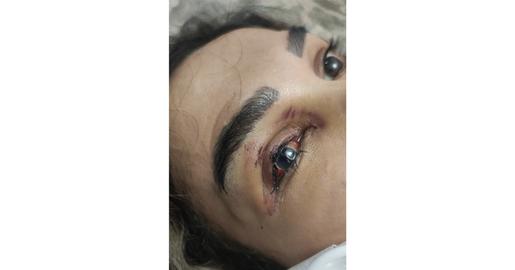 تشخیص داده شد نیازی به تخلیه‌ چشم‌ آسیب‌دیده‌اش نیست و چشم سالم مرسده، قوی مثل خودش، کاملا بینا است