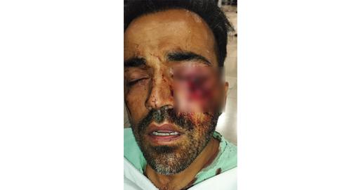 When Farzad Moradinia was admitted to a hospital in Tehran, he was told that they had allocated a whole ward to those who have been injured in the eye and they call it “Kurdistan Pellet Ward”