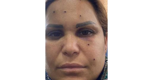 One pellet was lodged beneath Bahareh's eye and with two more were embedded in her eyebrow. Had they struck just a few millimeters higher or lower she may have lost one of her eyes