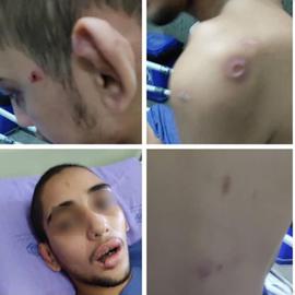 ضرب و شتم و سوزاندن بدن یک فرد دارای معلولیت در قائم‌شهر