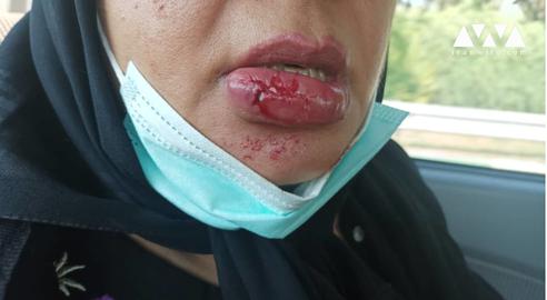 این دندانپزشک به دلیل خونریزی از ناحیه لب زودتر از دیگر همکارانش تجمع را ترک کرده است. او به «ایران وایر» می‌گوید: «مجبور شدم به مطبم خودم بیایم و با کمک یکی از دوستانم لبم را بخیه بزنم.»