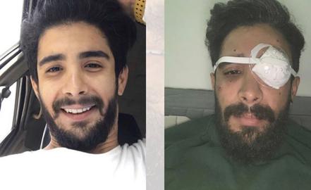 Farid Rashidi, before and after his injury