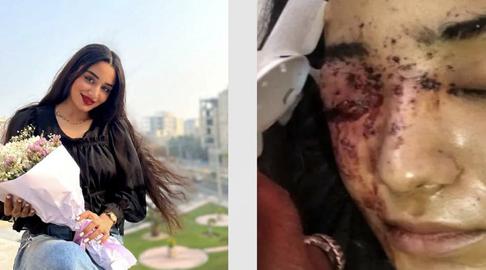Ghazal Ranjkesh, before and after her injury
