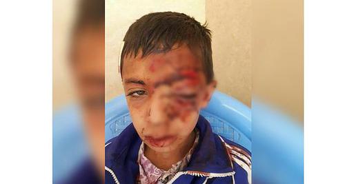 Iranians shared this photo of a schoolboy who was badly injured after he walked along treacherous mountain terrain to access the internet for school