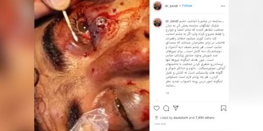 متخصص چشم در اصفهان: شلیک گلوله ساچمه‌ای مصداق جنایت است