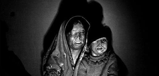 Acid Attack Victim Dies