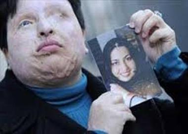 طرح تازه مجازات اسیدپاشی؛ حمایت های مثبت و مجازات های نگران کننده