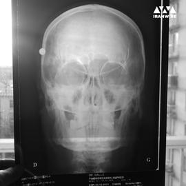 X-ray showing the pellet lodged in Alfred Yaghobzadeh's head