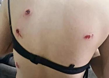 Wounds caused by buckshots