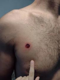 Wound caused by a lead bullet, probably from a paintball or buckshot